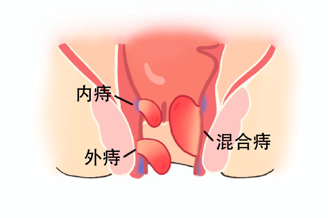 女生痔疮长啥样子的图片