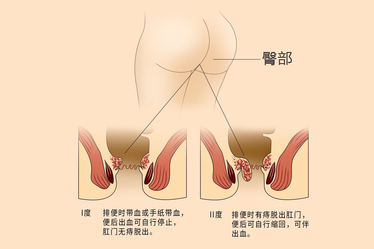 轻微痔疮图