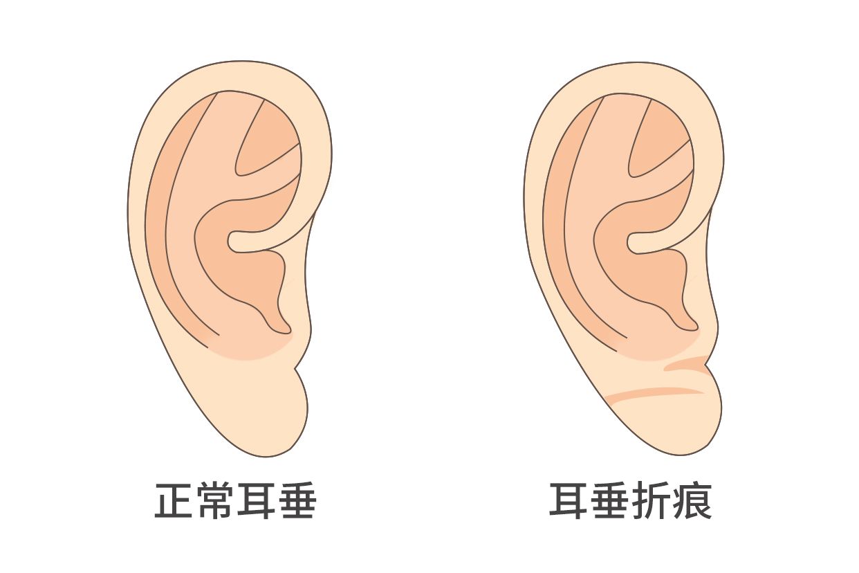 冠心病人耳垂折痕图