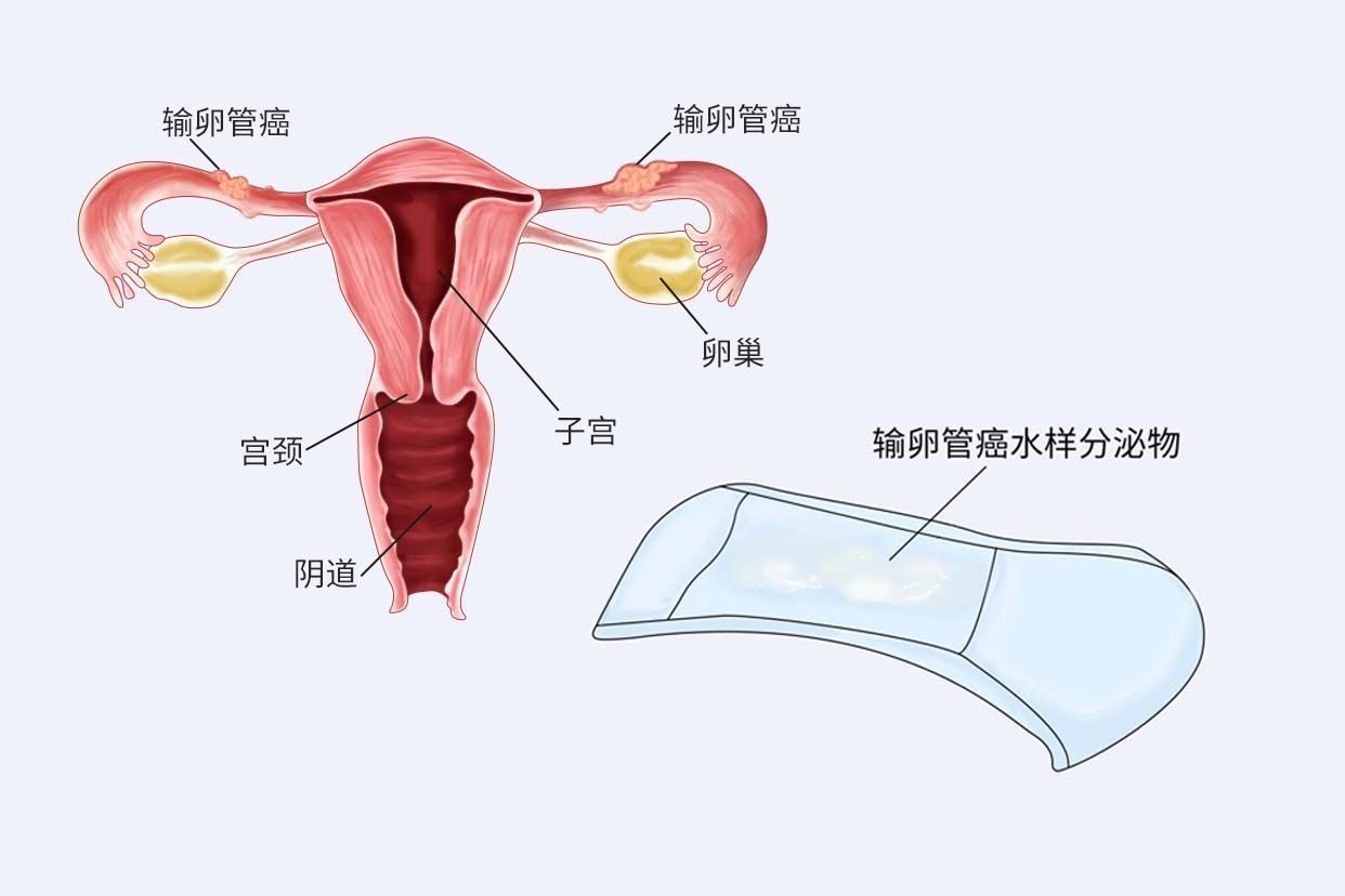 输卵管癌分泌物图