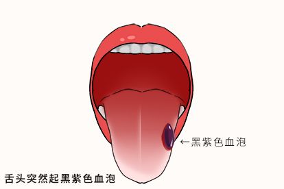 舌头起黑紫色血泡图