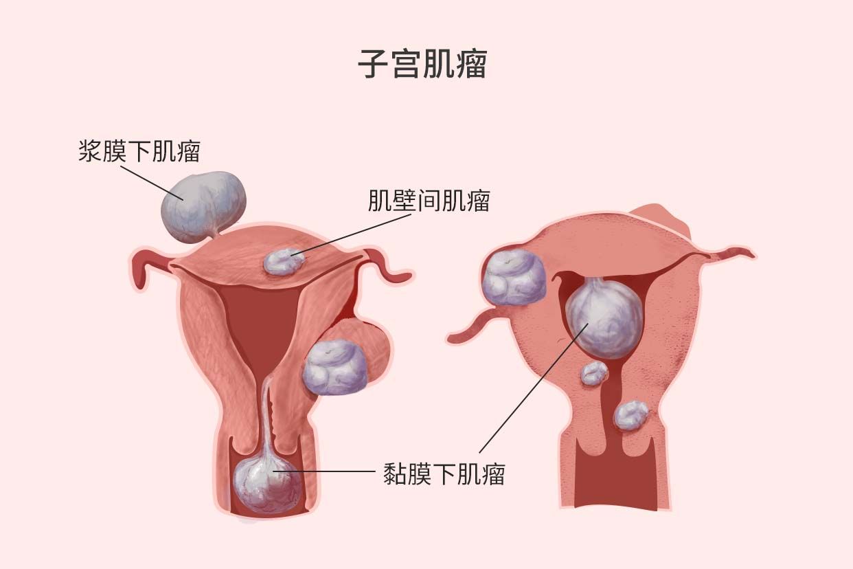 发现子宫肌瘤+子宫内膜息肉怎么办?
