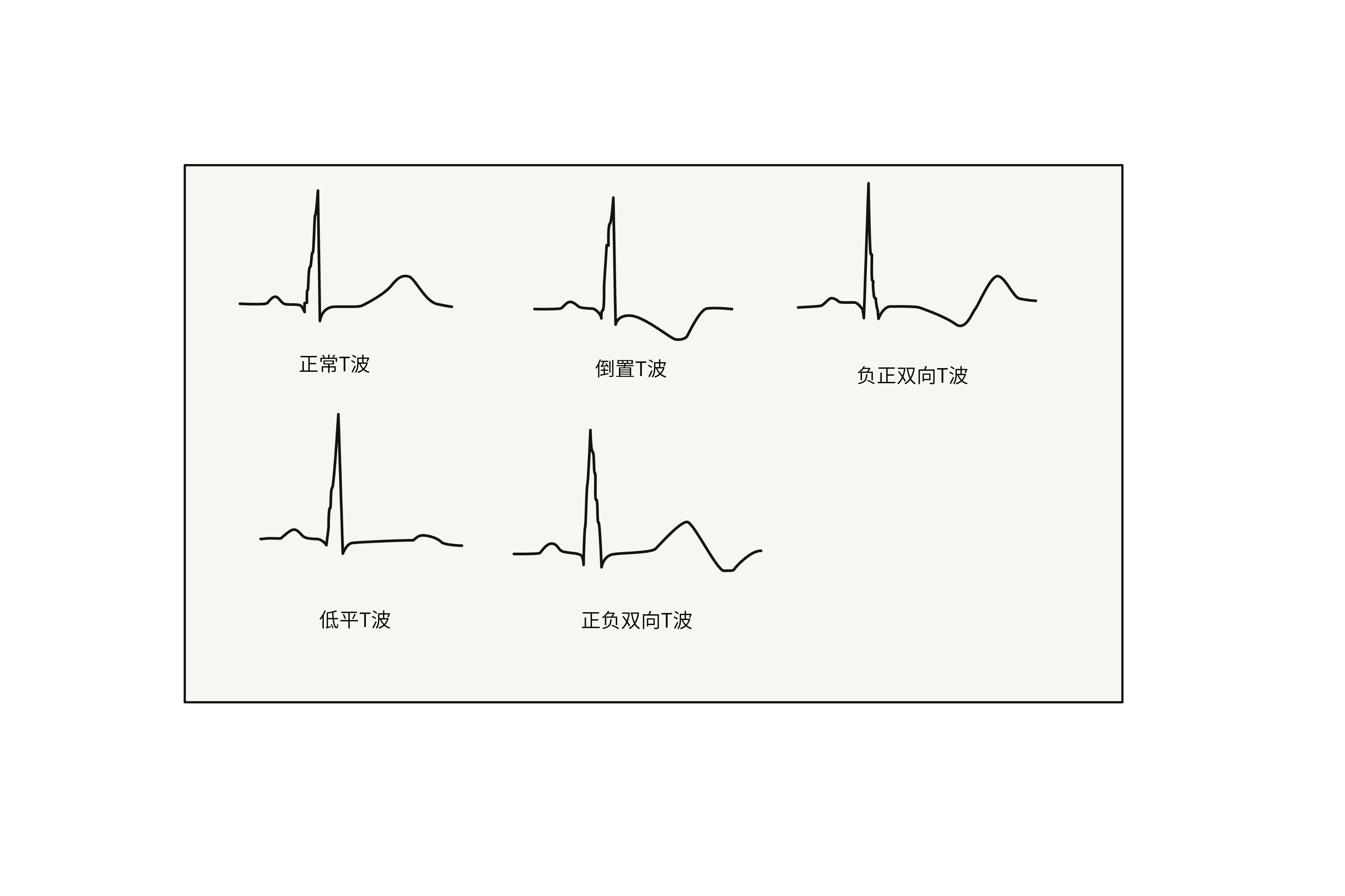心电图异常t波图片