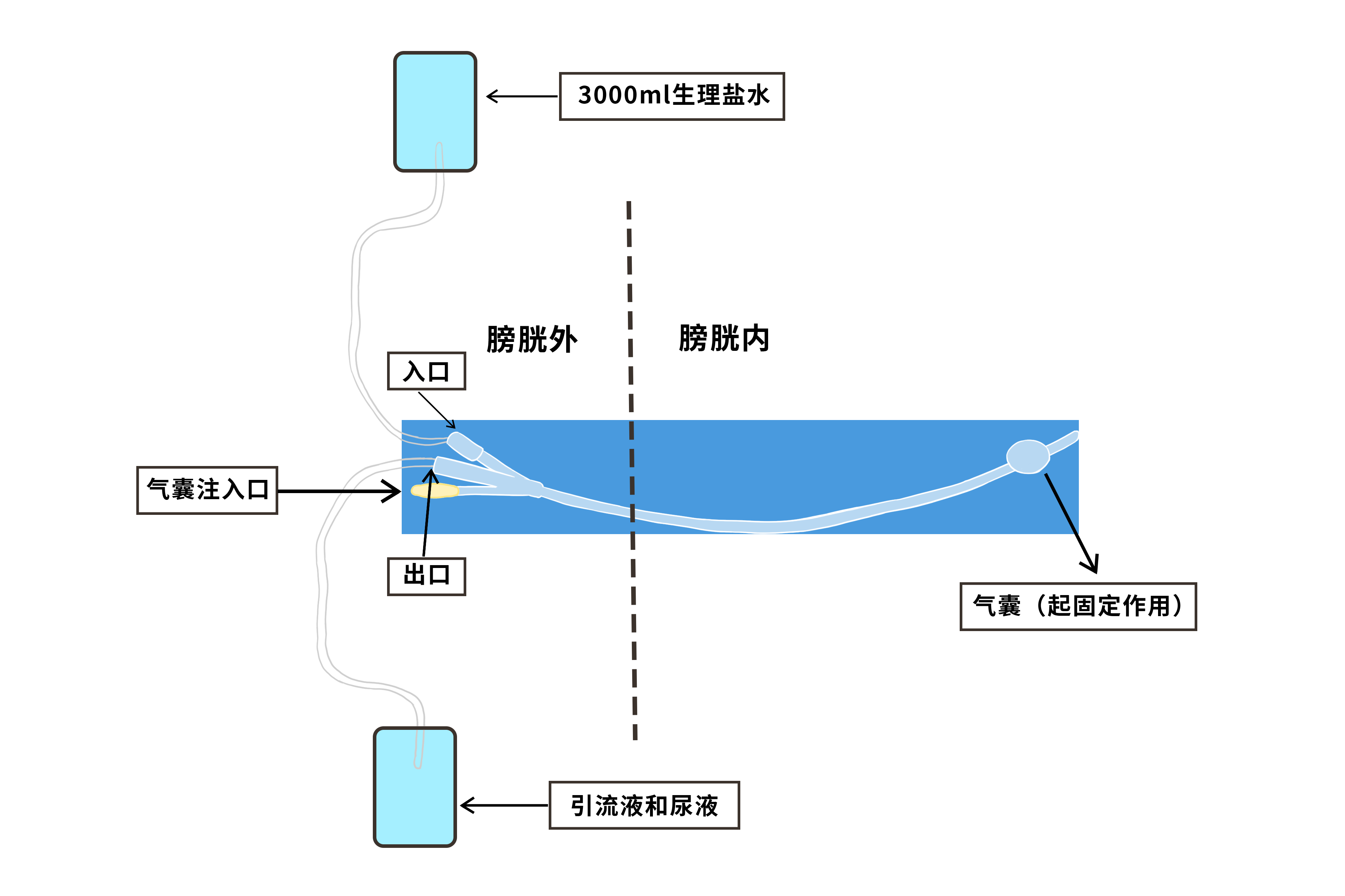 膀胱冲洗图