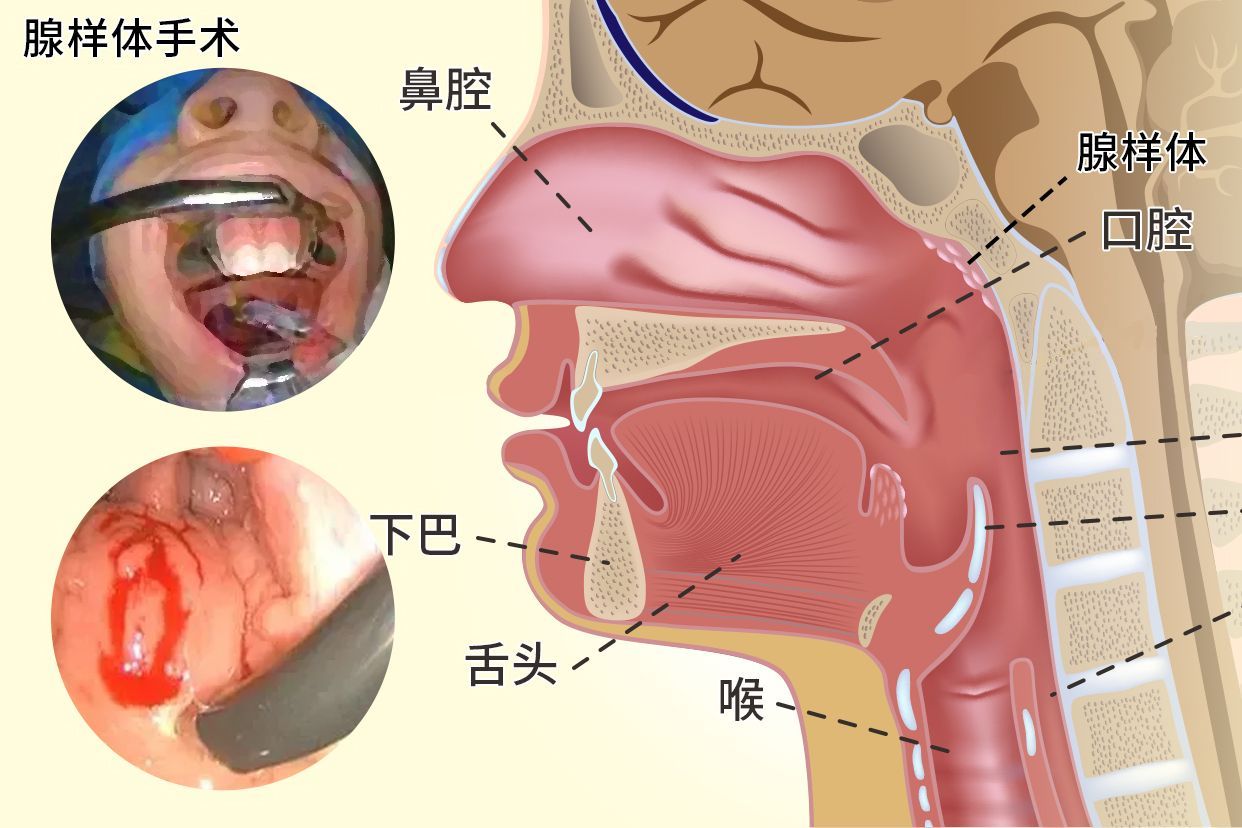 腺样体手术做不好会给宝宝带来怎样的危害?