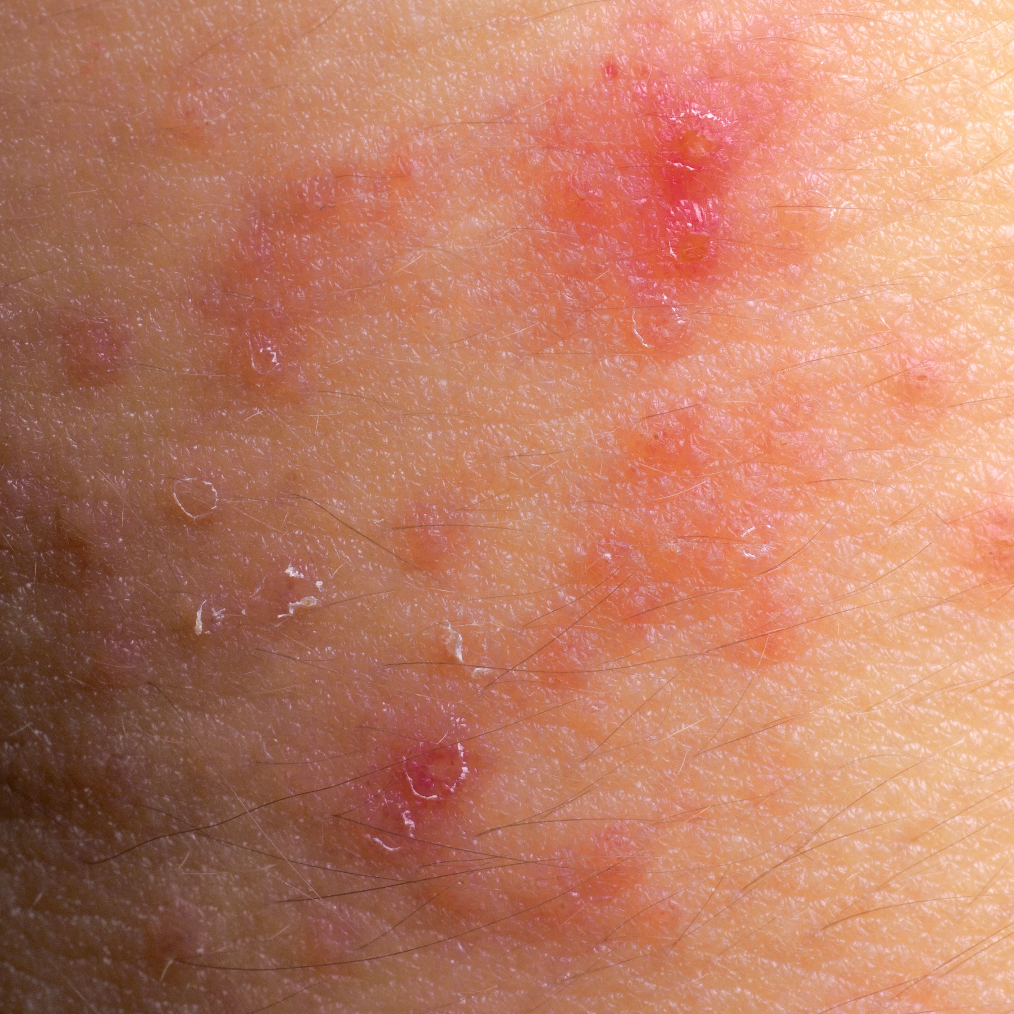 急性湿疹的4个主要症状