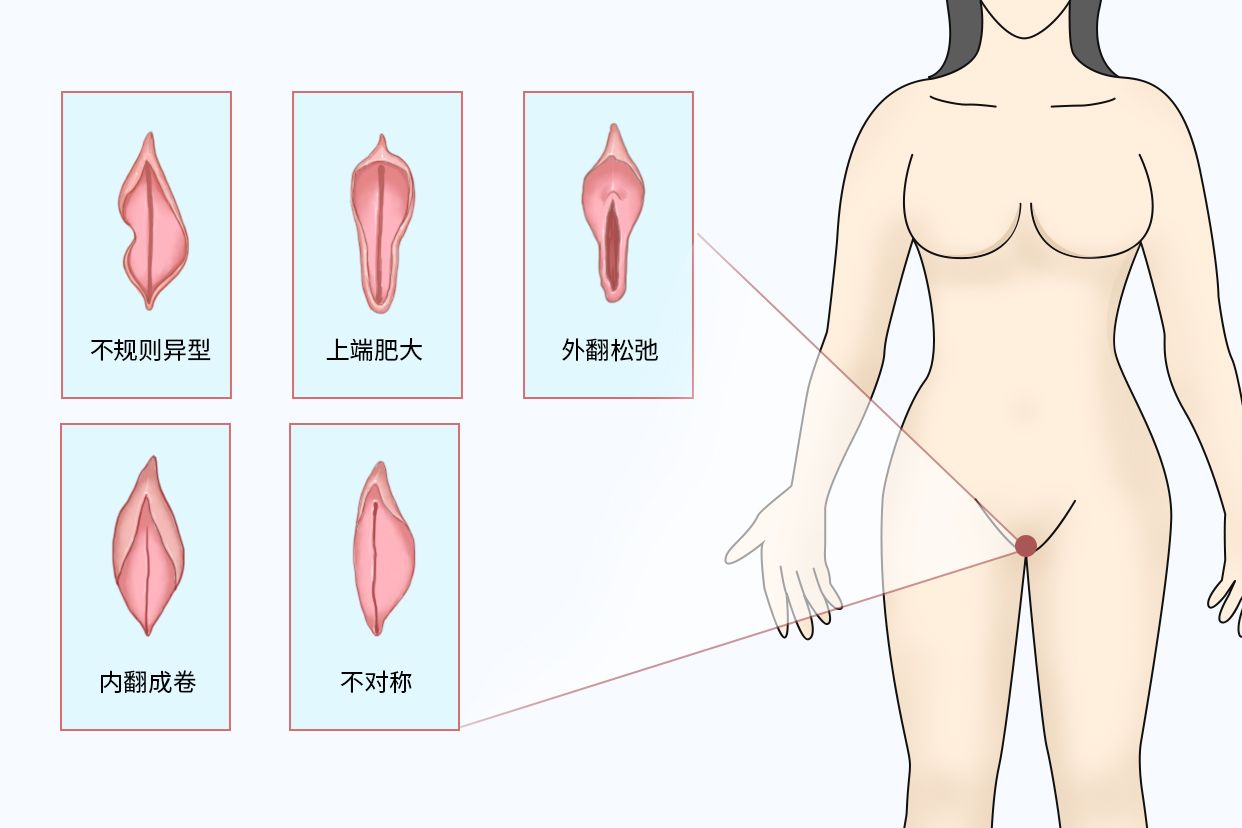 小阴唇 