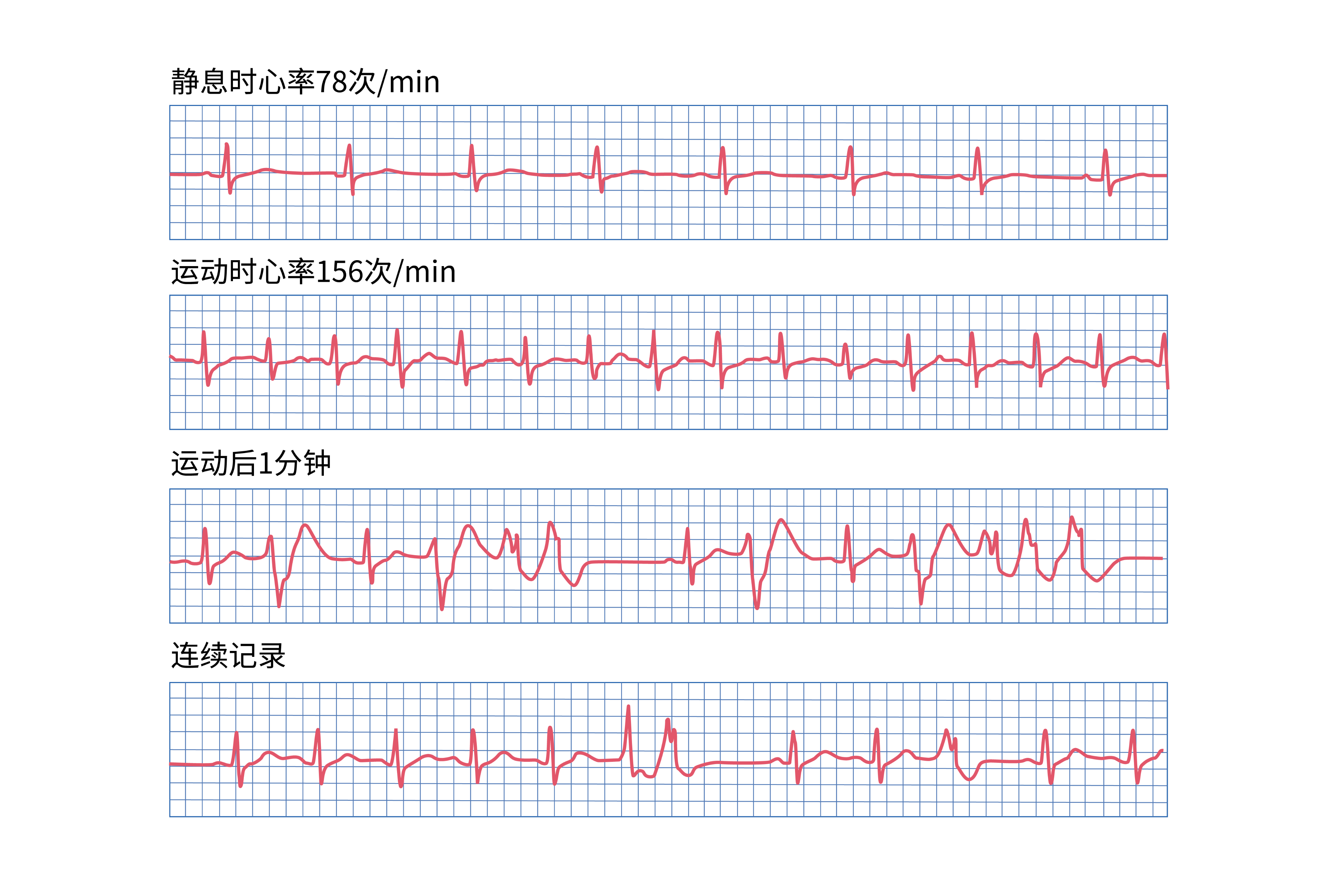 心电图运动平板试验图片