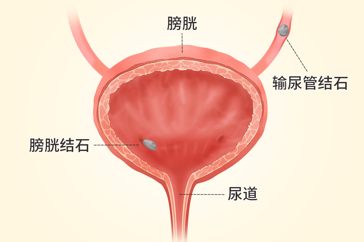 膀胱结石的部位图片图片