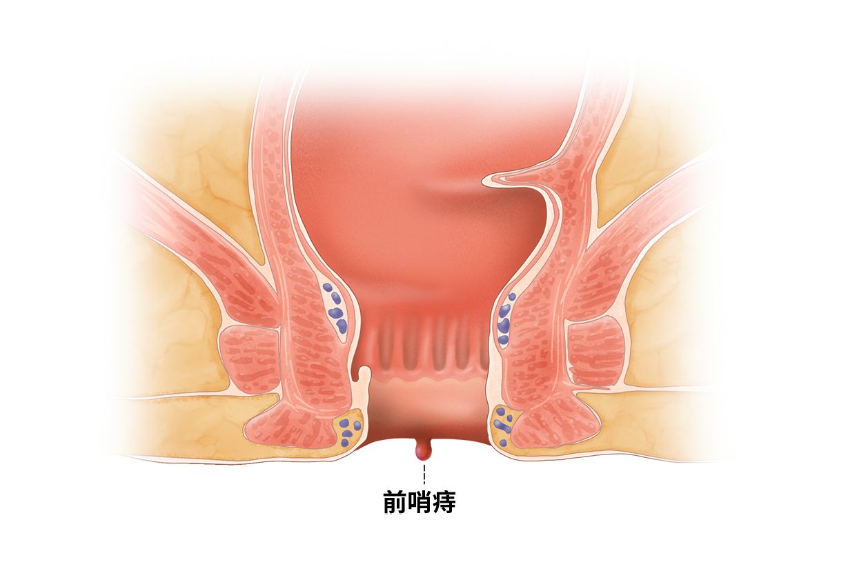 前哨痔