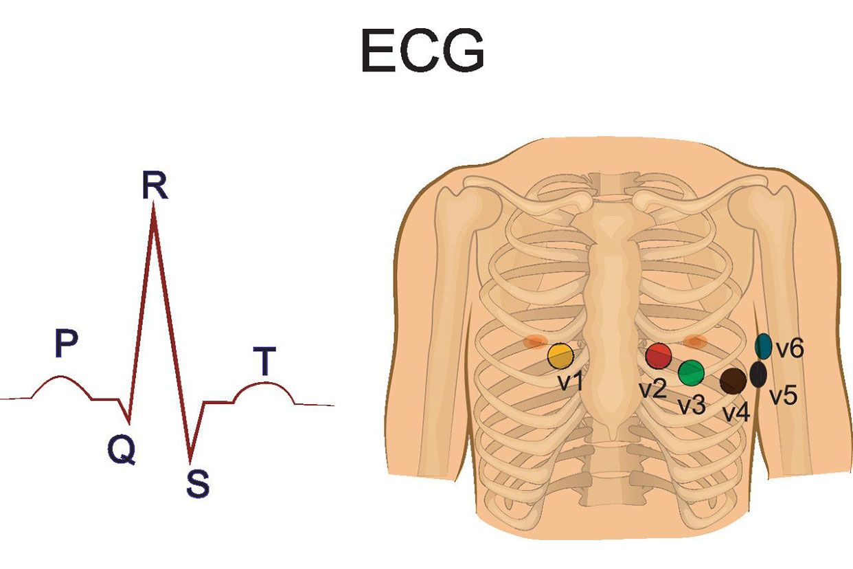 心电图前壁导联图