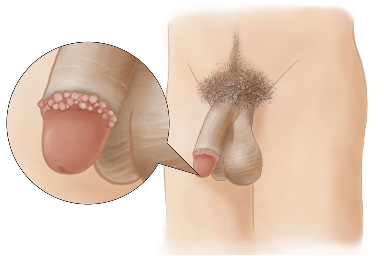 珍珠状阴茎丘疹图