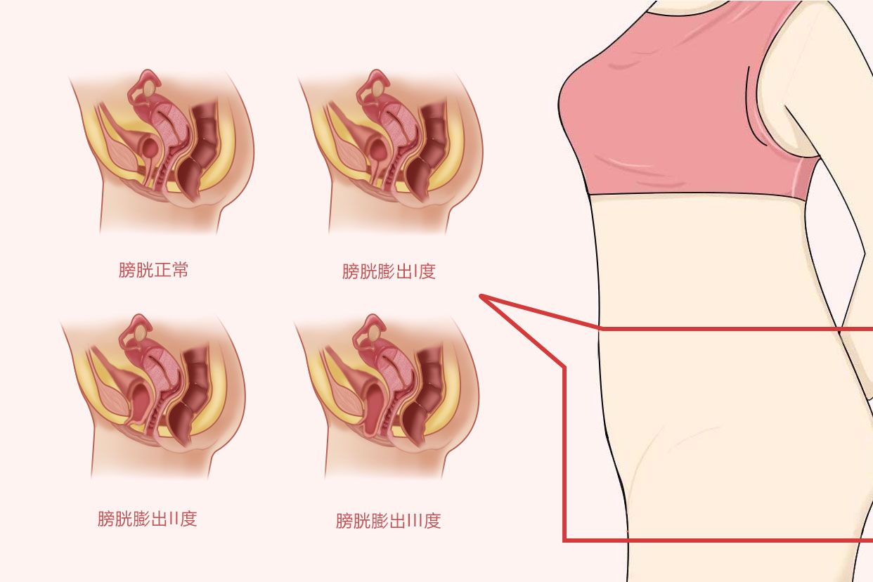 膀胱膨出图