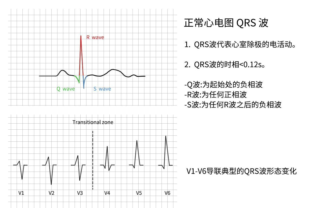 正常QRS波图