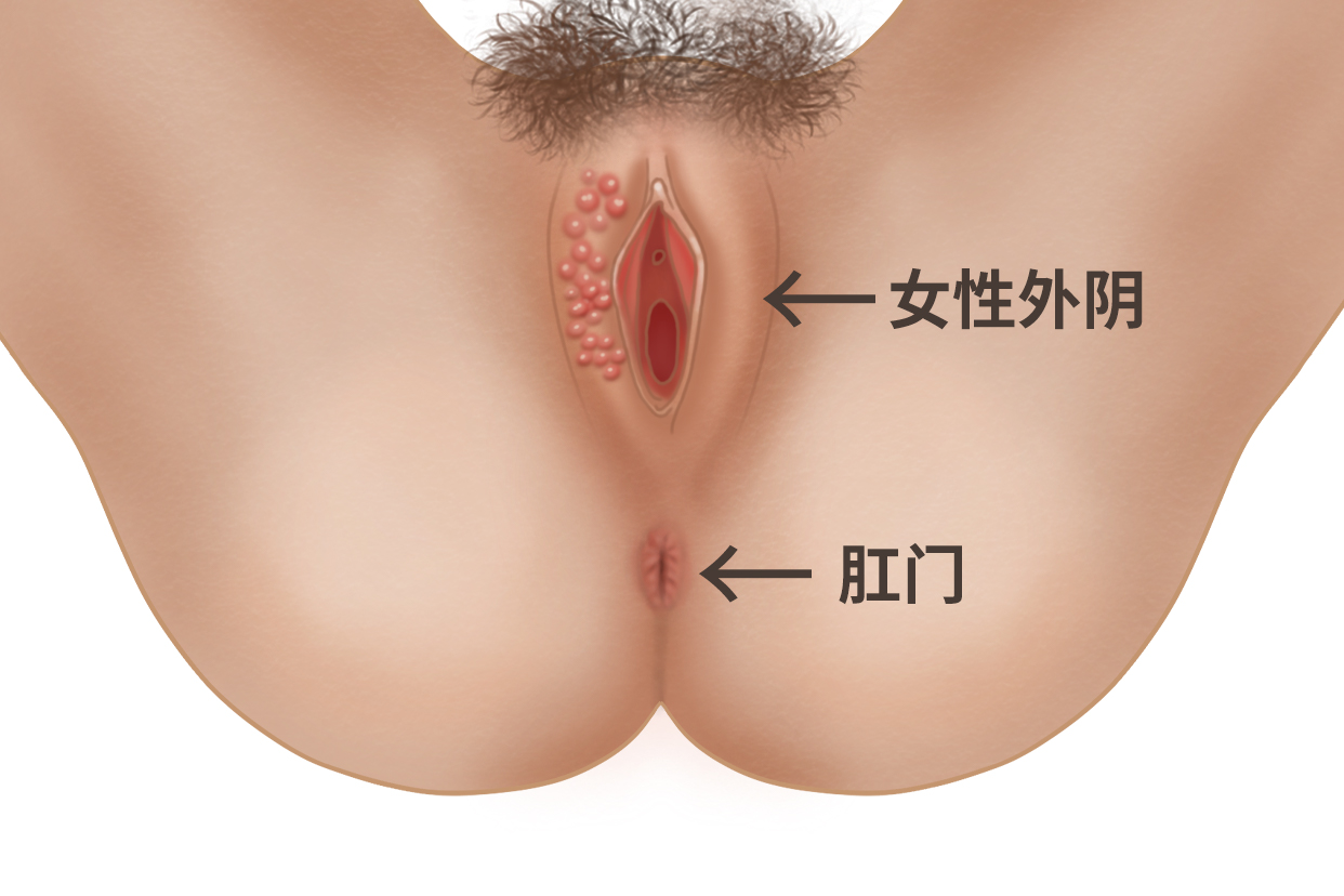 女生殖器疱疹图