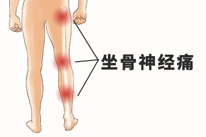 3个动作缓解坐骨神经痛 久坐屁股痛腰痛腿麻