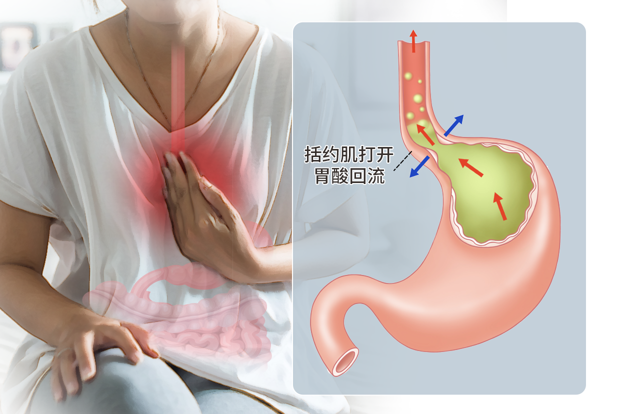 食道癌胸痛的位置图片图片