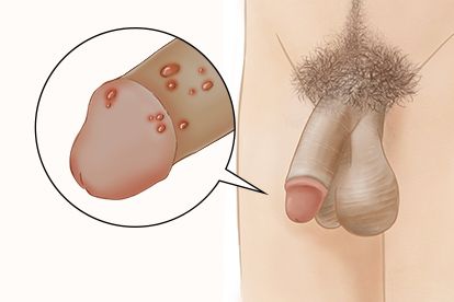 二期梅毒,常与哪些皮肤病混淆?