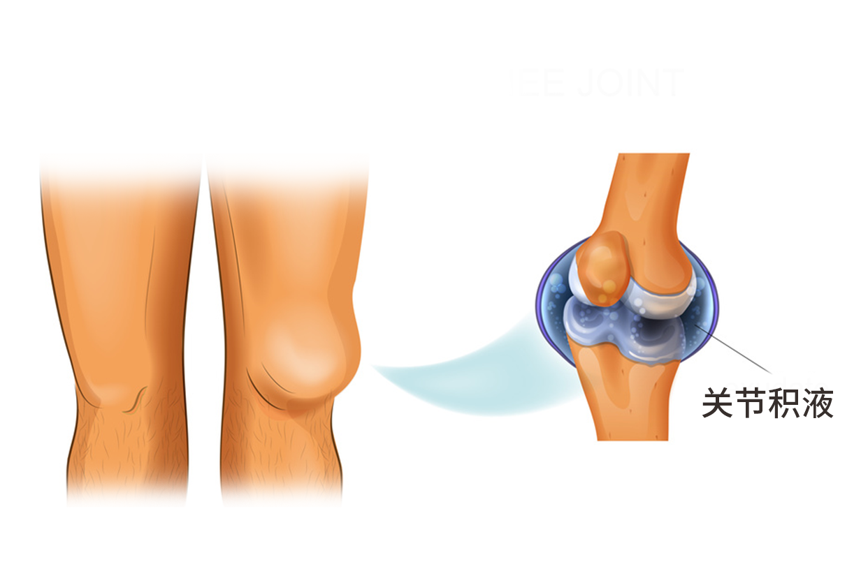 膝盖积液部位图片