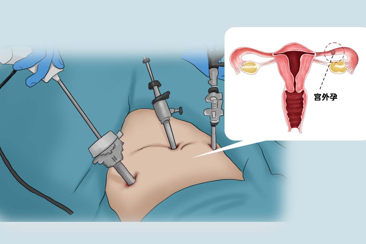 宫外孕手术位置图片图片