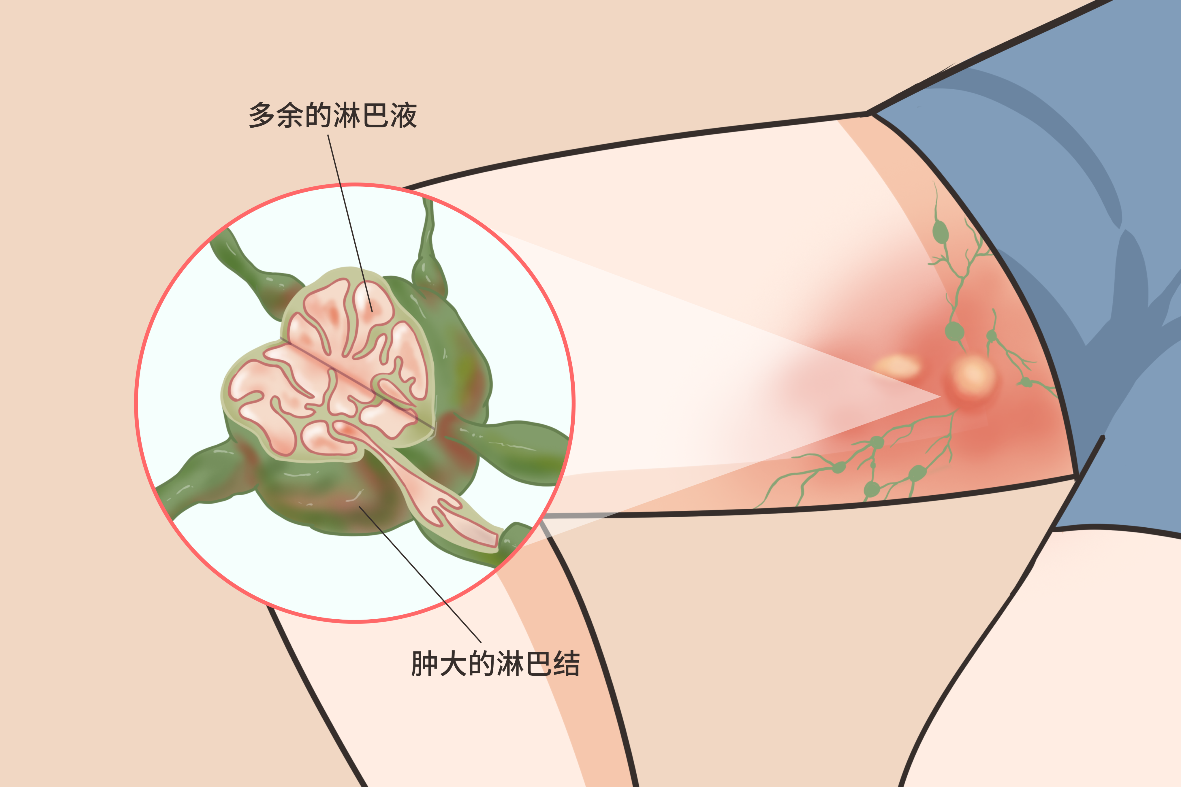 大腿内侧淋巴结肿大图