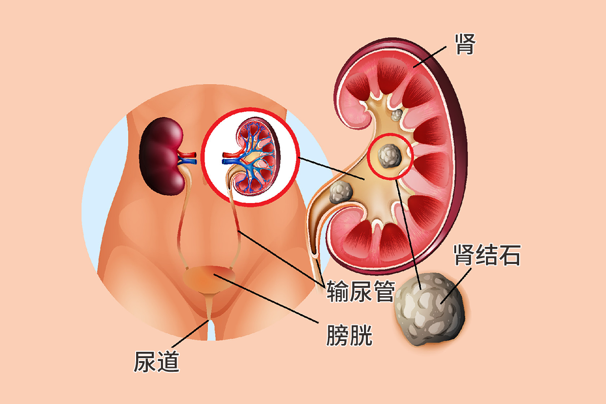 肾结石石头图片