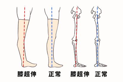 站直后小腿往后弯图