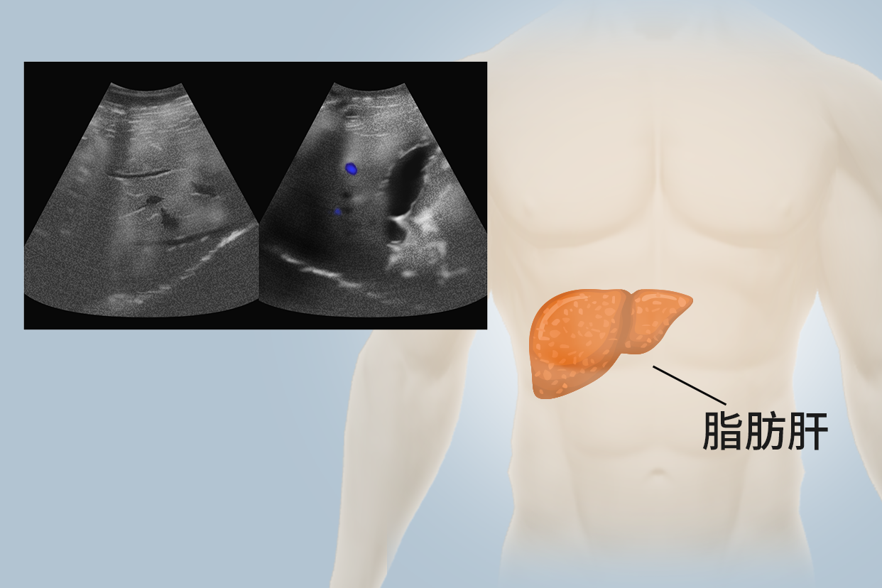 脂肪肝B超图