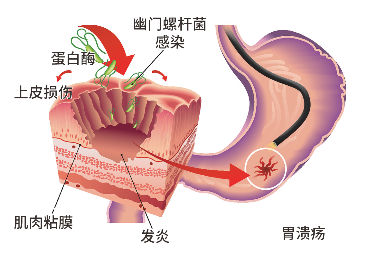 胃溃疡显微镜下图片