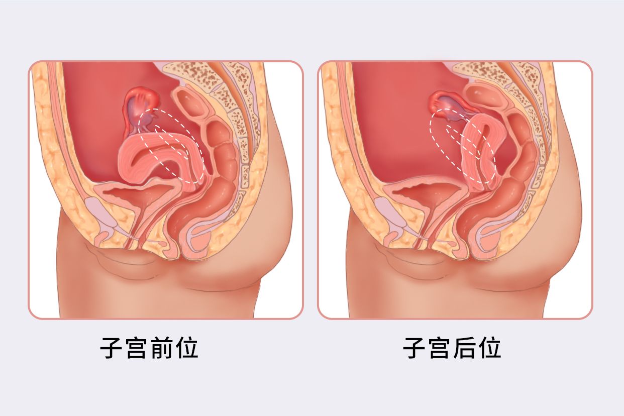 子宫后位图片对比