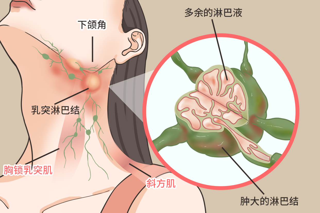 脖子淋巴结肿大位置图片