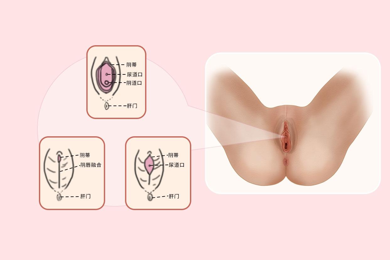 小阴唇 阴唇黏连图片_39健康网