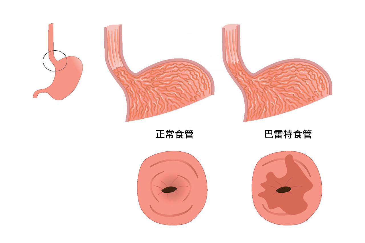 巴雷特食管图片