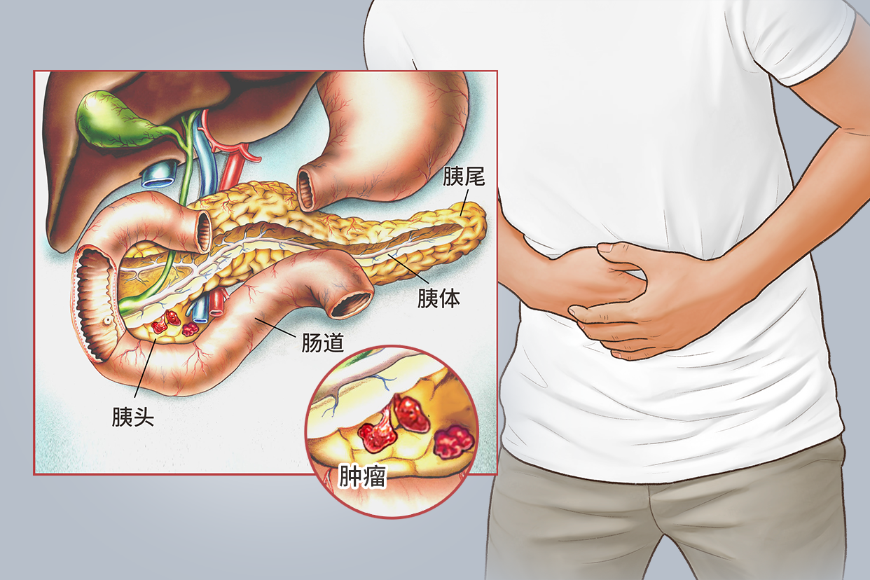 胰腺癌图