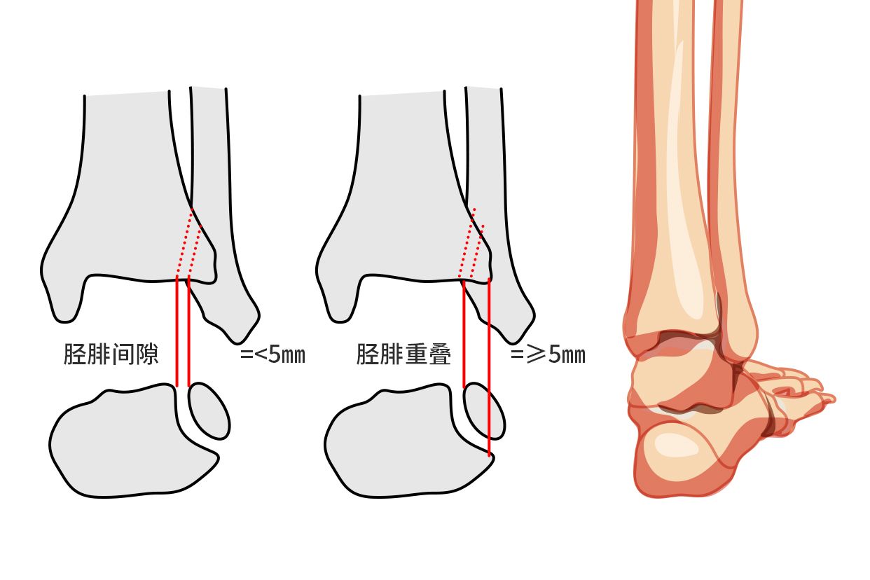 胫腓关节分离图片