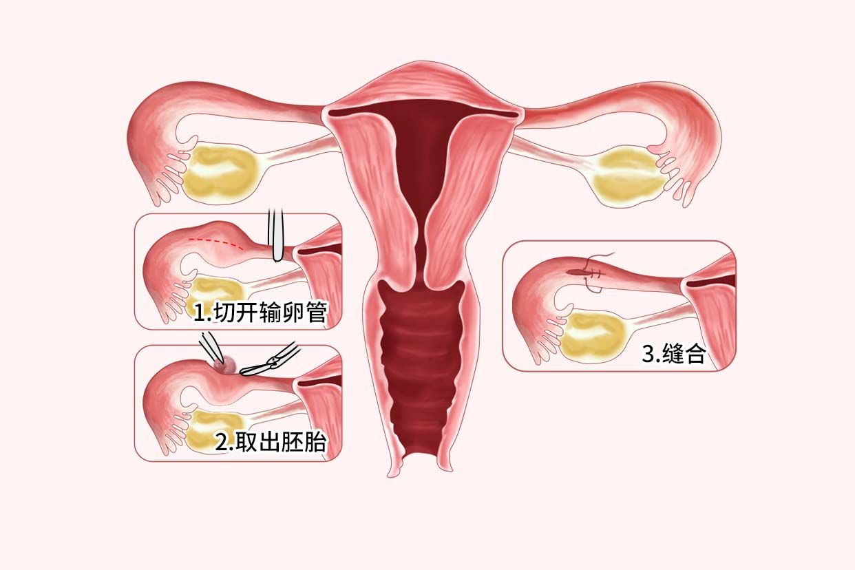 宫外孕腹腔镜手术步骤图解