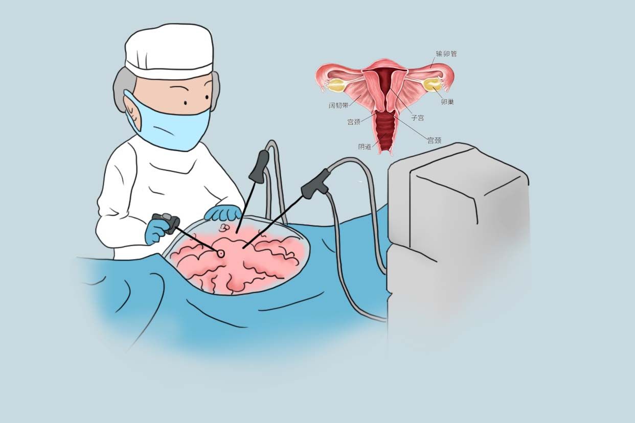 子宫全切手术图步骤图片
