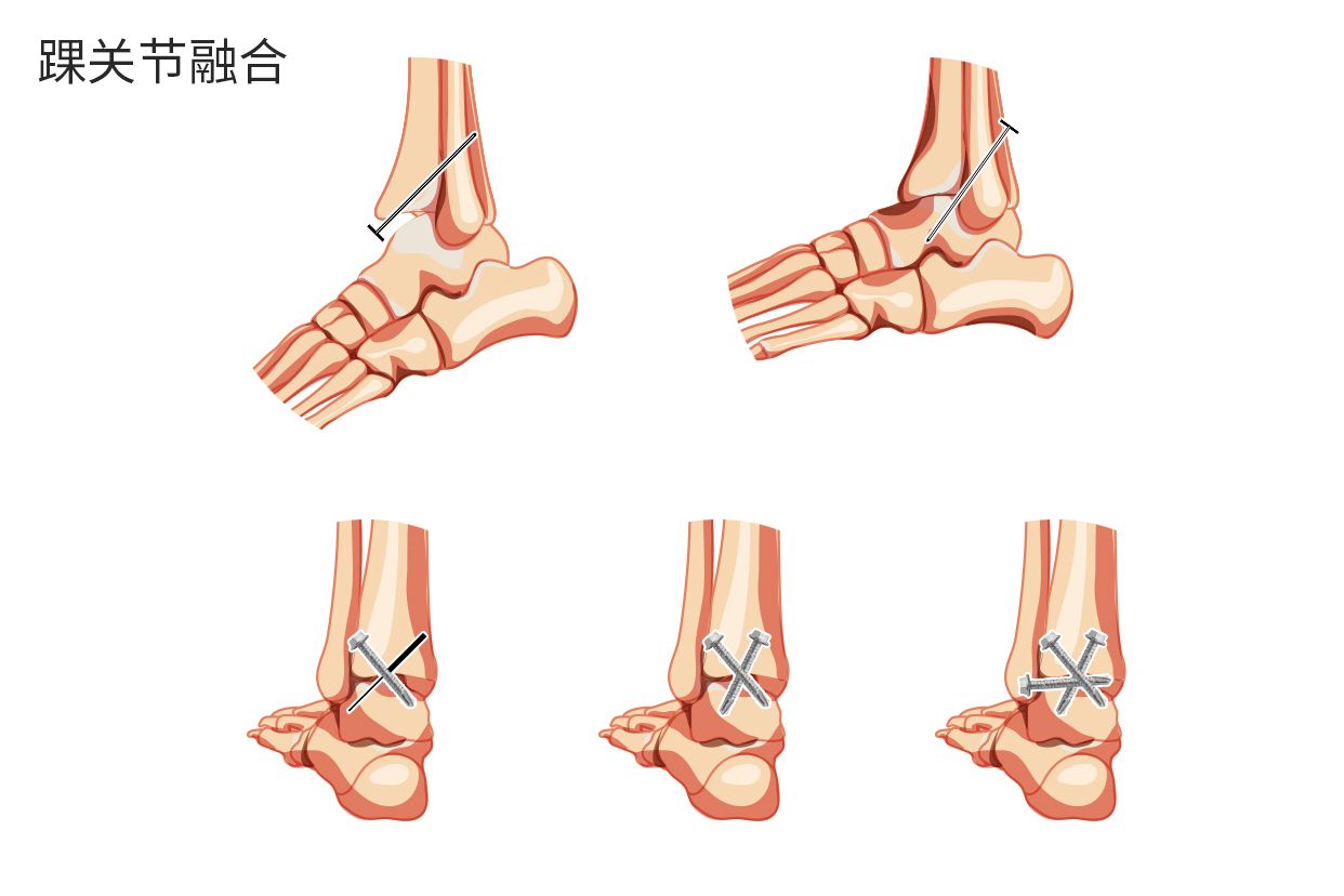 踝关节融合图片