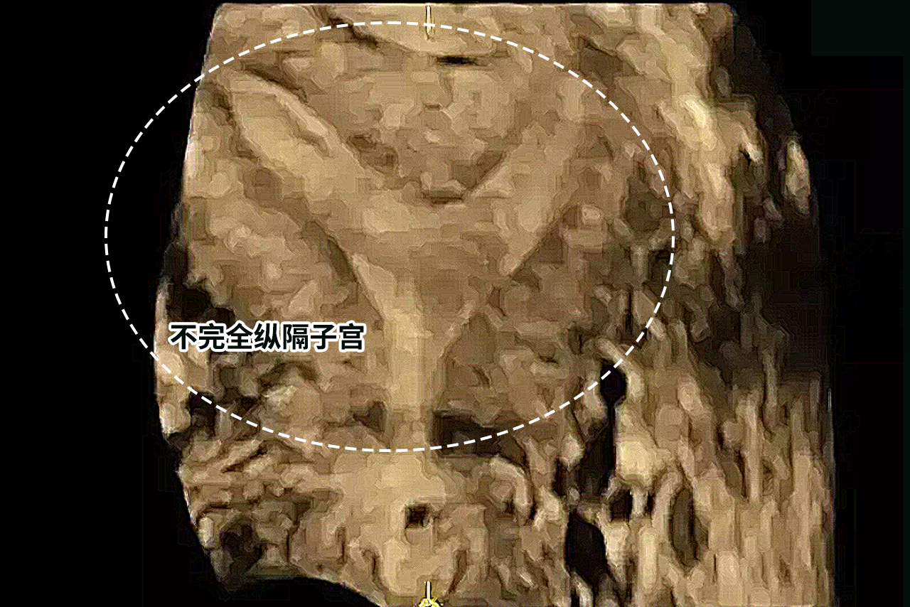 不全纵隔子宫y型图片图片