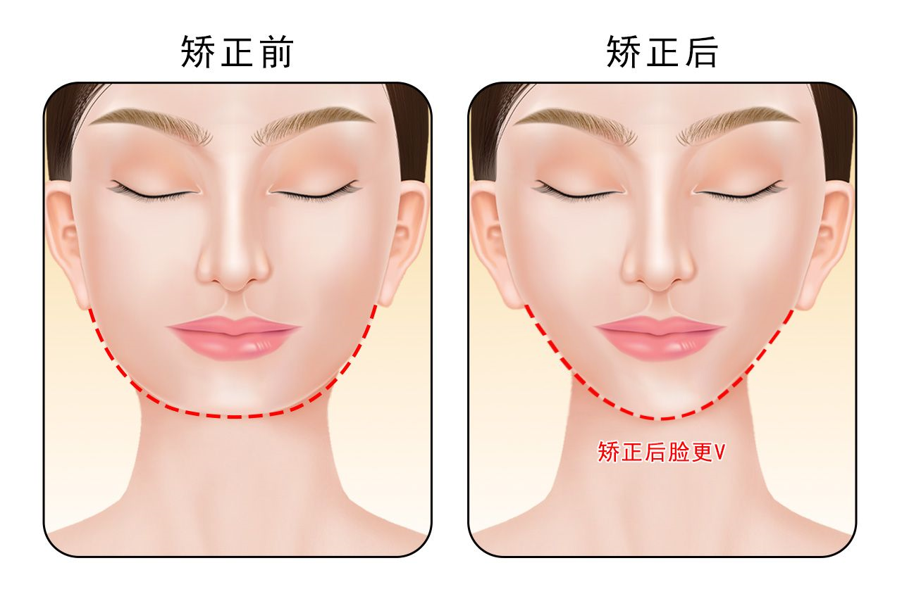 深覆盖矫正脸型变化图