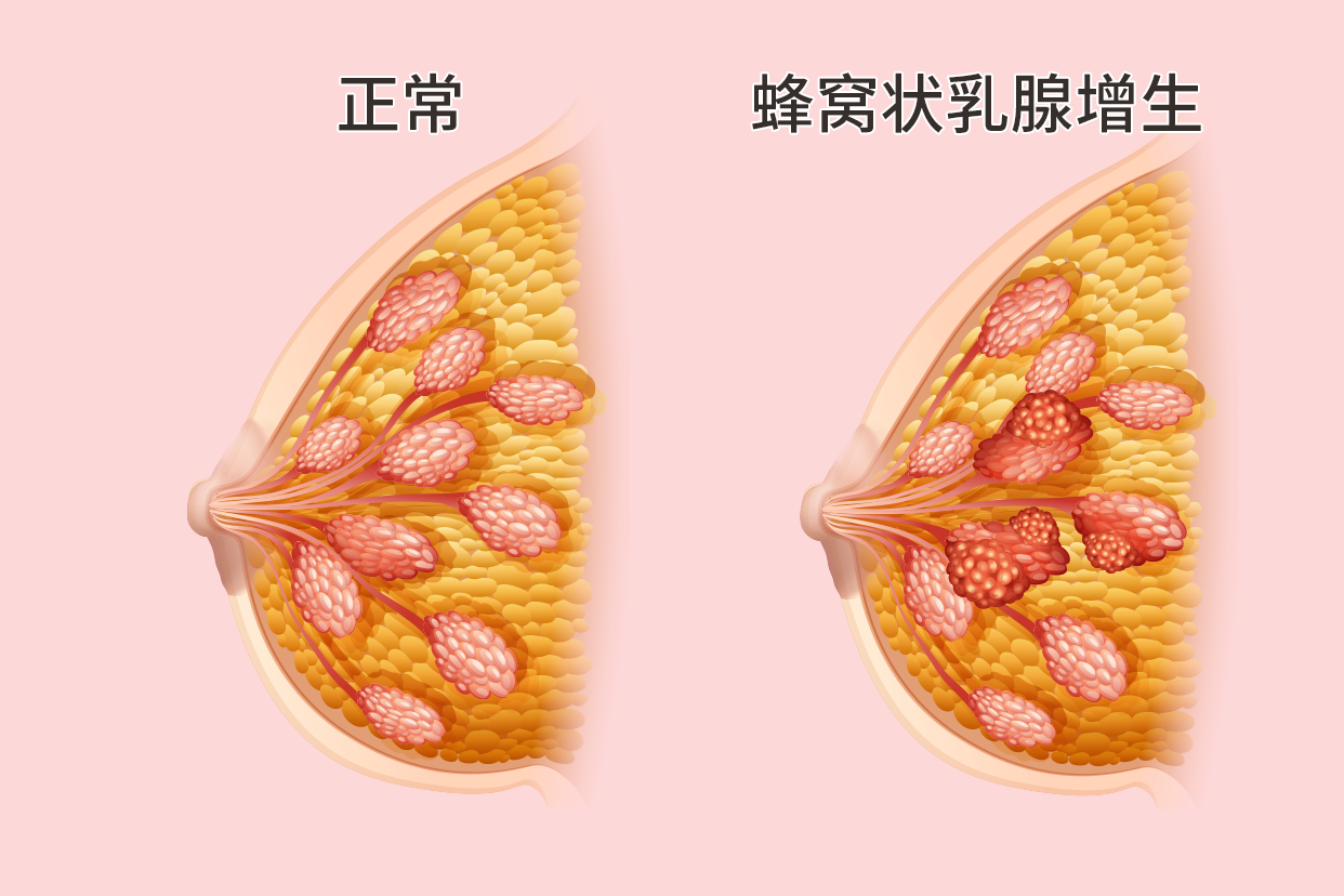 乳腺增生三期症状图片图片