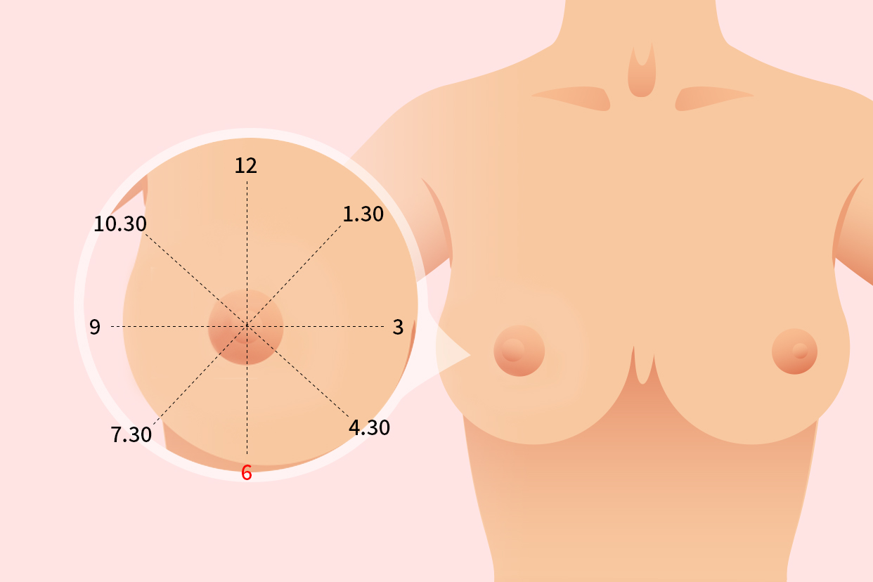 乳腺结节6点钟位置图片