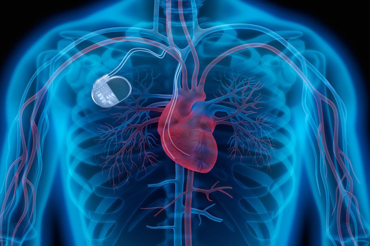 什么人需要心脏起搏器?它是怎么工作的?