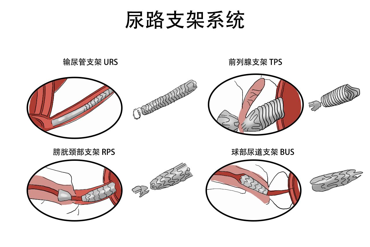 永久性尿道支架图片