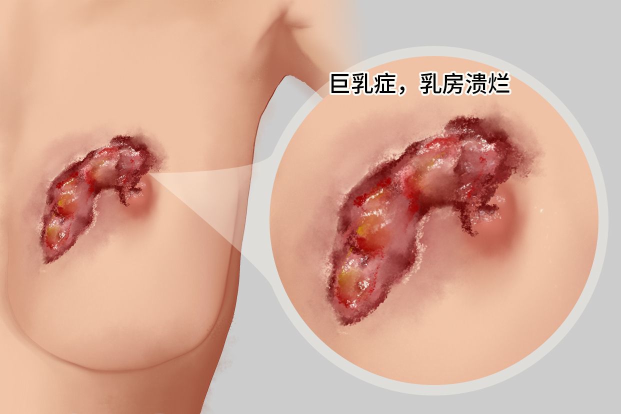 巨乳症 