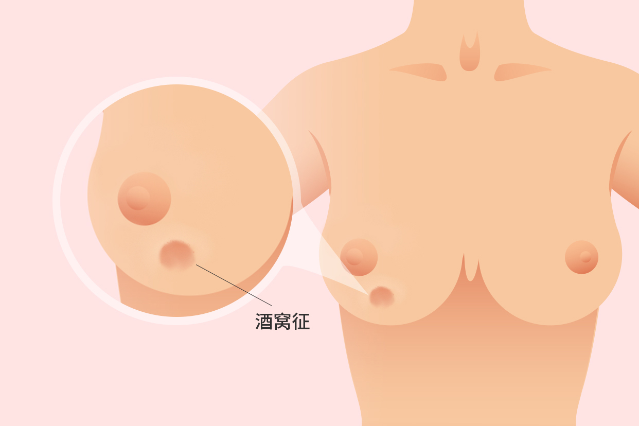 乳腺癌酒窝征清晰图片