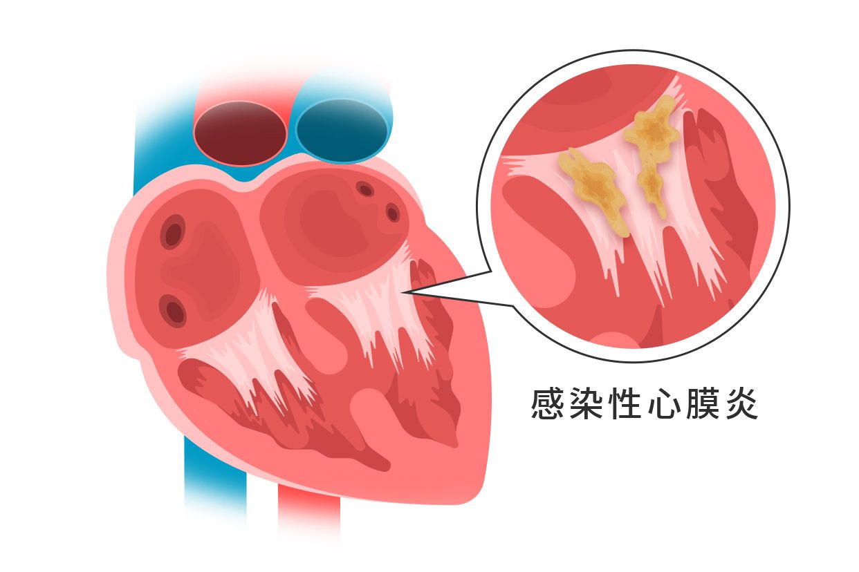 感染性心内膜炎皮疹图片