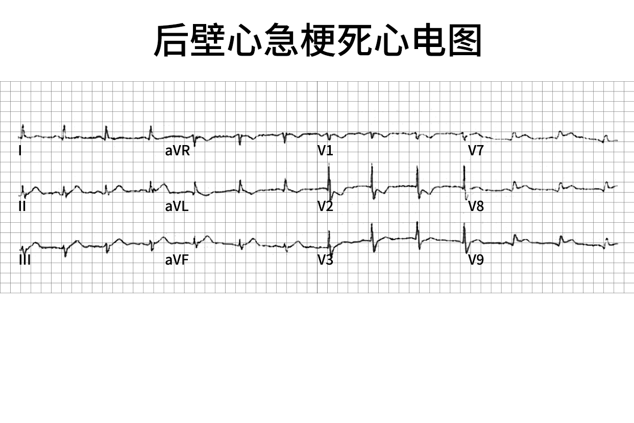 后壁心急梗死心电图图片
