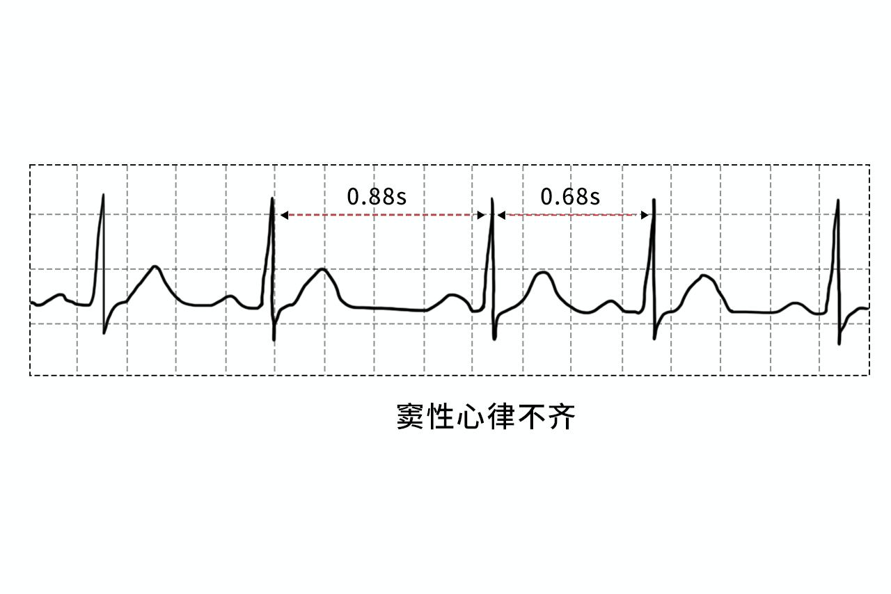 窦性心律不齐图形