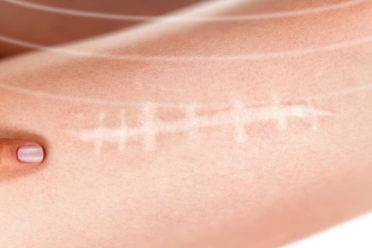纳米光波去疤痕一般需要几次治疗